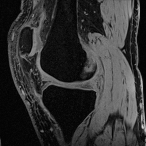 Anterior cruciate ligament tear - ramp lesion (Radiopaedia 71883-82322 Sagittal T1 vibe 89).jpg