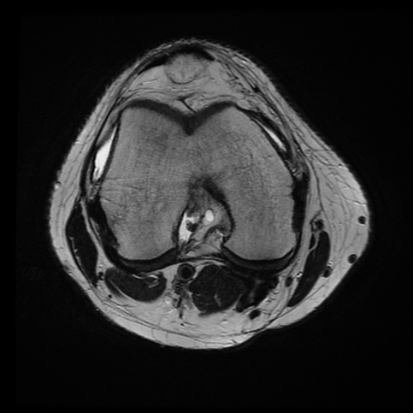 File:Anterior cruciate ligament tear with posteromedial corner injury, bucket-handle meniscal tear and chondral delamination (Radiopaedia 75501-86744 Axial T2 14).jpg