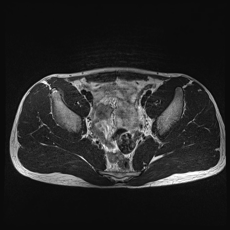 File:Anterior inferior iliac spine avulsion fracture (Radiopaedia 81312-95000 Axial T2 26).jpg