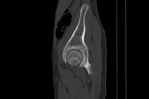 Anterior inferior iliac spine avulsion injury (Radiopaedia 88666-105376 Sagittal bone window 73).jpg
