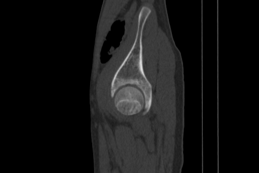 Anterior inferior iliac spine avulsion injury (Radiopaedia 88666-105376 Sagittal bone window 75).jpg