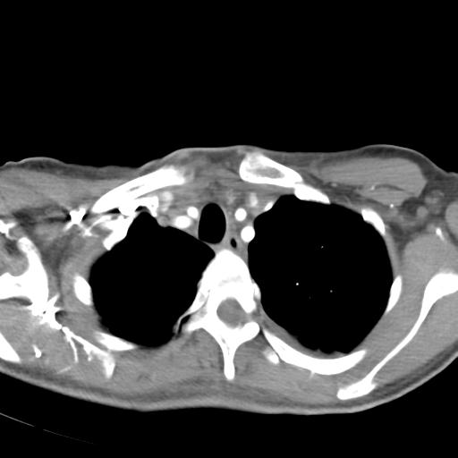 Anterior mediastinal lymphoma (Radiopaedia 29556-30061 C 9).jpg