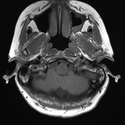 File:Anterior temporal encephalocele (Radiopaedia 82624-96808 Axial T1 3).jpg
