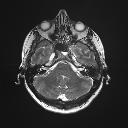 File:Anterior temporal encephalocele (Radiopaedia 82624-96808 Axial T2 8).jpg