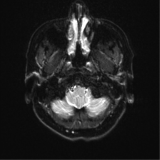 Anterior temporal lobe perivascular space (Radiopaedia 40946-43650 Axial DWI 2).png