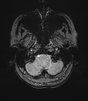Anterior temporal lobe perivascular space (Radiopaedia 40946-43650 Axial SWI 9).png