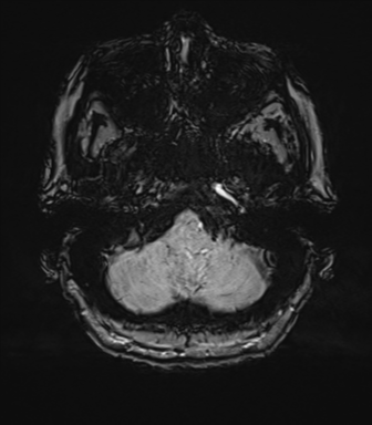 Anterior temporal pole cysts (Radiopaedia 46629-51102 Axial SWI 15).png