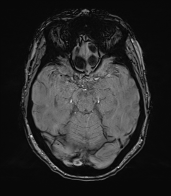 Anterior temporal pole cysts (Radiopaedia 46629-51102 Axial SWI 35).png