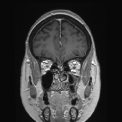 Anterior temporal pole cysts (Radiopaedia 46629-51102 Coronal T1 C+ 135).png