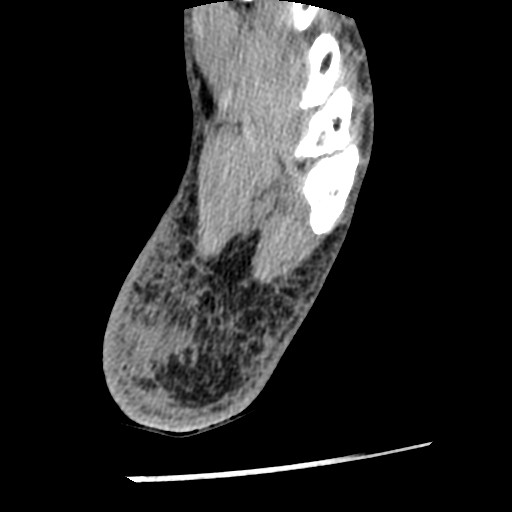 Anterior tibial artery false aneurysm (Radiopaedia 88984-105809 A 231).jpg