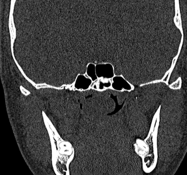 Antrochoanal polyp (Radiopaedia 30002-30554 Coronal bone window 69).jpg