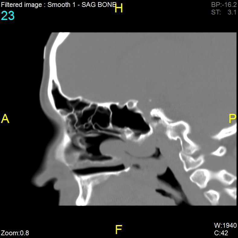 Antrochoanal polyp (Radiopaedia 65101-74094 Sagittal bone window 23).jpg