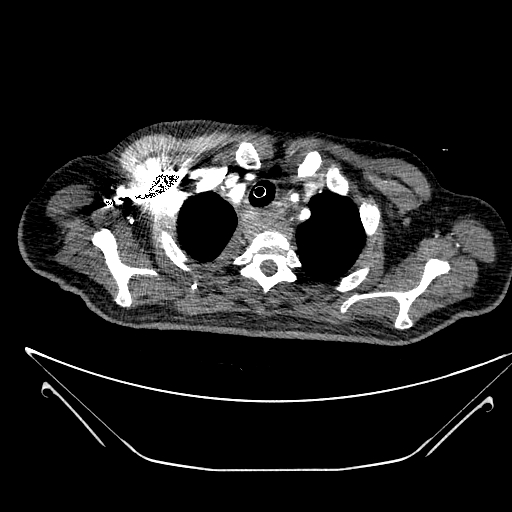 Aortic arch aneurysm (Radiopaedia 84109-99365 B 100).jpg
