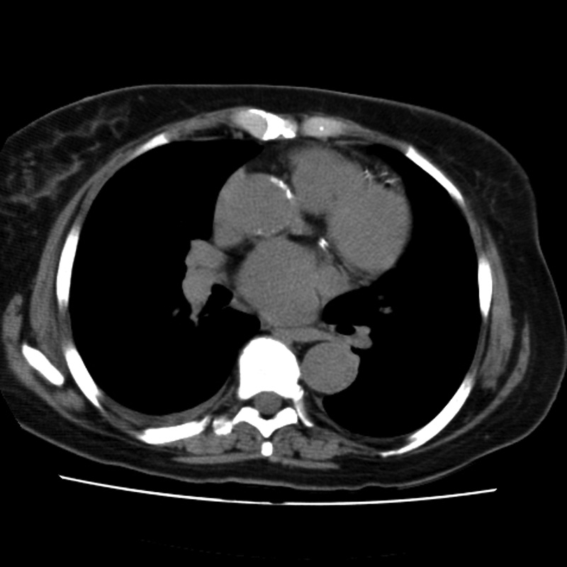 Aortic arch pseudoaneurysm (Radiopaedia 8534-9368 Axial non-contrast 41).jpg