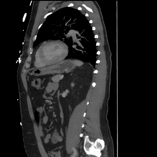 File:Aortic dissection- Stanford A (Radiopaedia 37759-39664 Sagittal C+ delayed 30).png