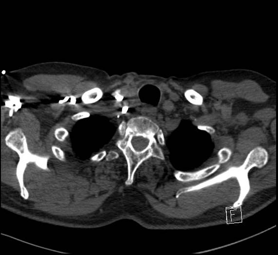 Aortic dissection (CTPA) (Radiopaedia 75506-86751 Axial C+ CTPA 12).jpg
