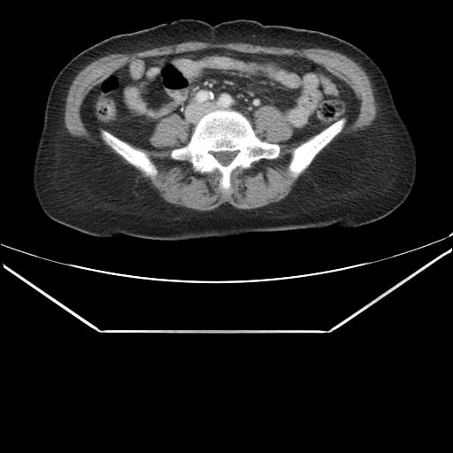 File:Aortic dissection (Radiopaedia 25350-25604 C 74).jpg