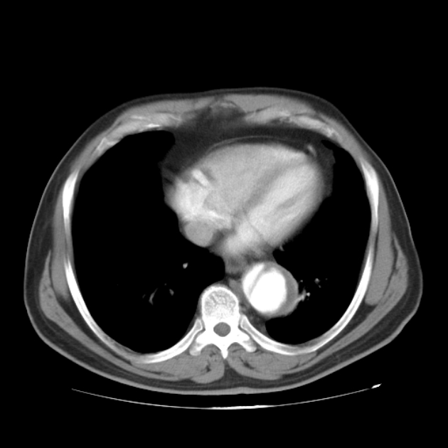 Aortic dissection (Radiopaedia 44411-48061 C 19).jpg