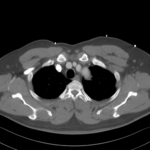 Aortic dissection (Radiopaedia 50763-56234 A 2).png