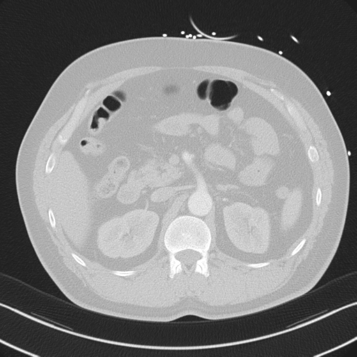 File:Aortic dissection (Radiopaedia 50763-56234 Axial lung window 71).png