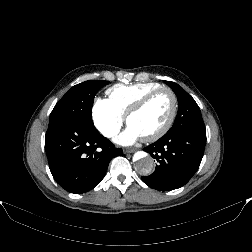 Aortic dissection - Stanford type A (Radiopaedia 83418-98500 A 43).jpg