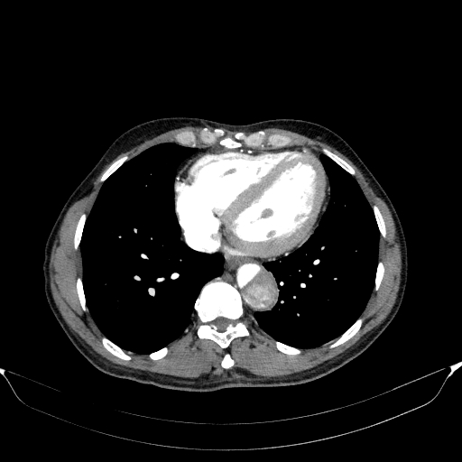 File:Aortic dissection - Stanford type A (Radiopaedia 83418-98500 A 46).jpg