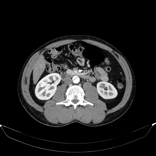 Aortic dissection - Stanford type A (Radiopaedia 83418-98500 A 79).jpg