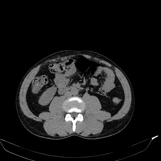 Aortic dissection - Stanford type A (Radiopaedia 83418-98500 Axial non-contrast 61).jpg