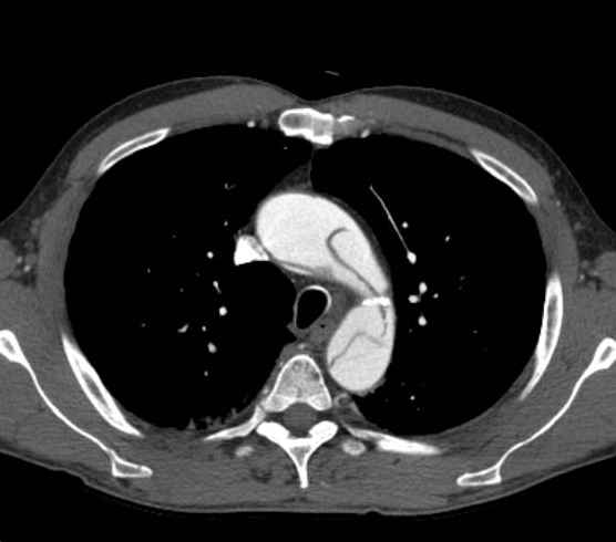 Aortic dissection - Stanford type B (Radiopaedia 73648-84437 A 26).jpg