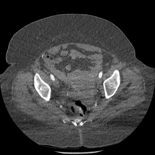 Aortic dissection - Stanford type B (Radiopaedia 88281-104910 A 151).jpg