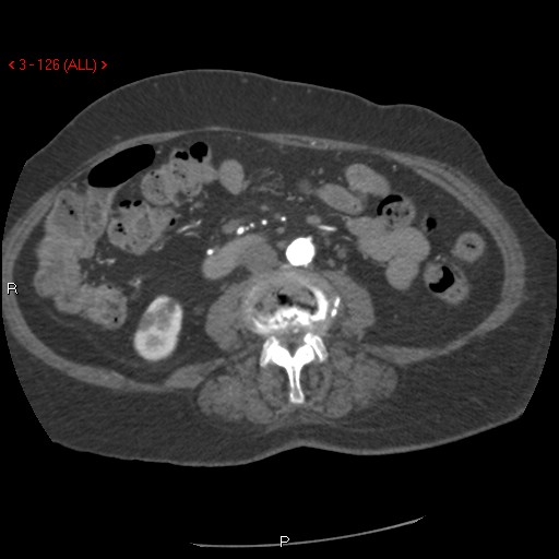 Aortic intramural hematoma (Radiopaedia 27746-28001 A 126).jpg