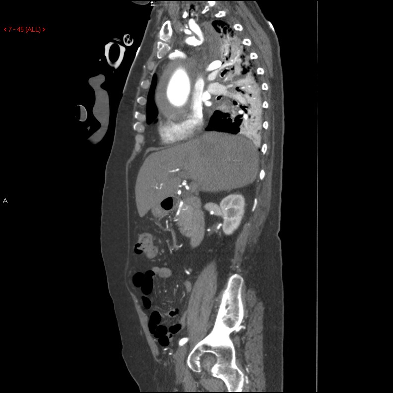 Aortic intramural hematoma (Radiopaedia 27746-28001 C 14).jpg