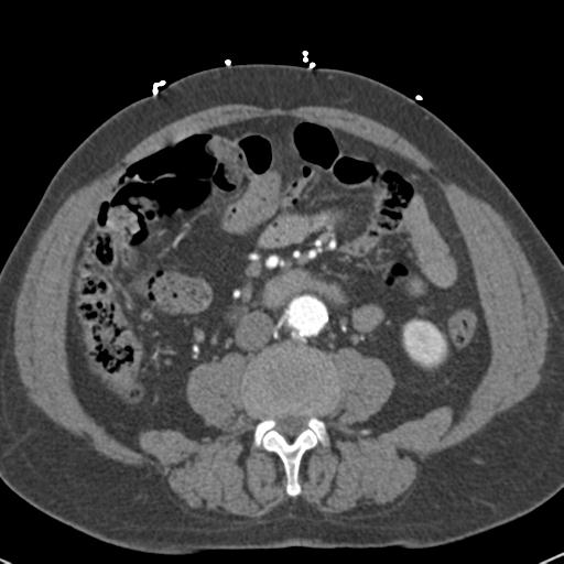 Aortic intramural hematoma (Radiopaedia 31139-31838 B 114).jpg