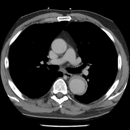 Aortic intramural hematoma (type B) (Radiopaedia 79323-92387 Axial C+ delayed 22).jpg