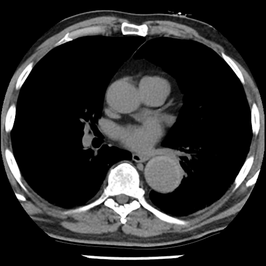 Aortic intramural hematoma (type B) (Radiopaedia 79323-92387 Axial non-contrast 28).jpg