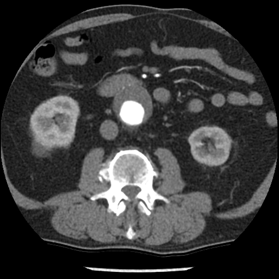 Aortic intramural hematoma (type B) (Radiopaedia 79323-92387 B 74).jpg