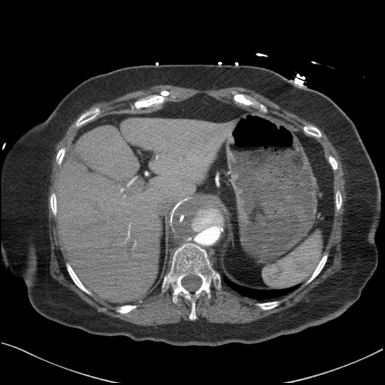 Aortic intramural hematoma with dissection and intramural blood pool (Radiopaedia 77373-89491 B 102).jpg