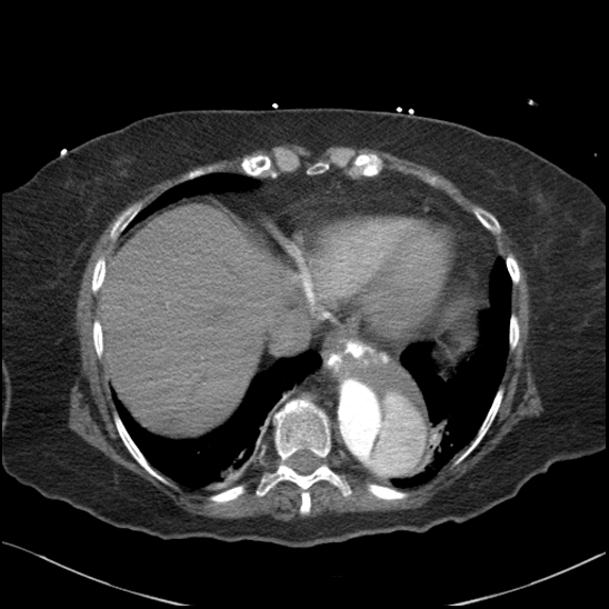 Aortic intramural hematoma with dissection and intramural blood pool (Radiopaedia 77373-89491 B 87).jpg