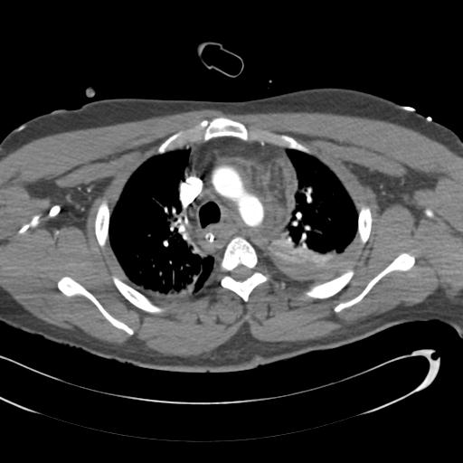 Aortic transection, diaphragmatic rupture and hemoperitoneum in a complex multitrauma patient (Radiopaedia 31701-32622 A 29).jpg