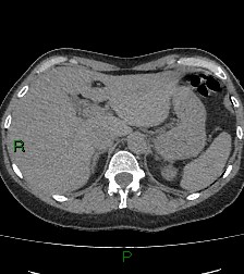 File:Aortic valve endocarditis (Radiopaedia 87209-103485 Axial non-contrast 93).jpg