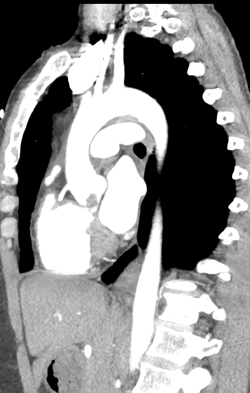 Aortic valve non-coronary cusp thrombus (Radiopaedia 55661-62189 C+ arterial phase 27).png