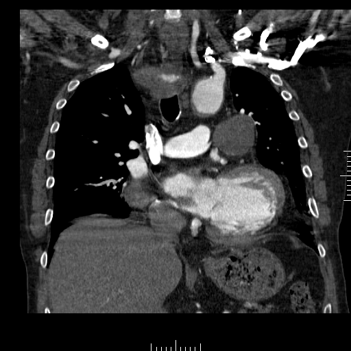File:Aorto-coronary bypass graft aneurysms (Radiopaedia 40562-43157 B 21).png