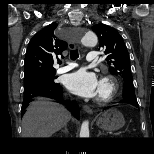 File:Aorto-coronary bypass graft aneurysms (Radiopaedia 40562-43157 B 24).png