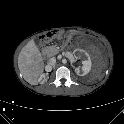 File:Aorto-left renal vein fistula (Radiopaedia 45534-49628 A 20).jpg