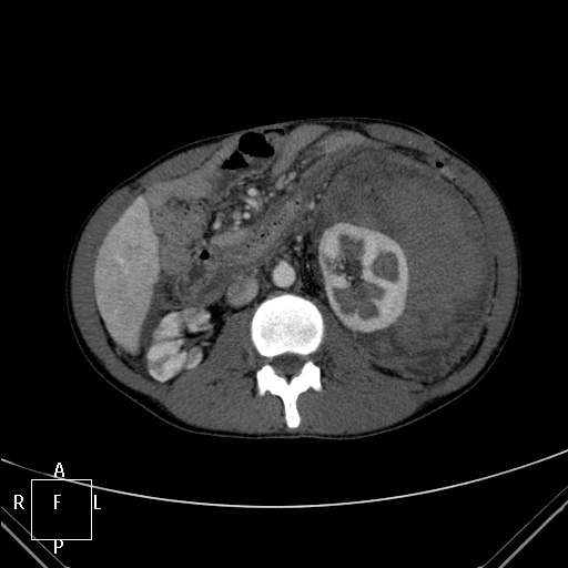 File:Aorto-left renal vein fistula (Radiopaedia 45534-49628 A 28).jpg