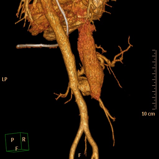 File:Aorto-left renal vein fistula (Radiopaedia 45534-49628 D 28).jpg