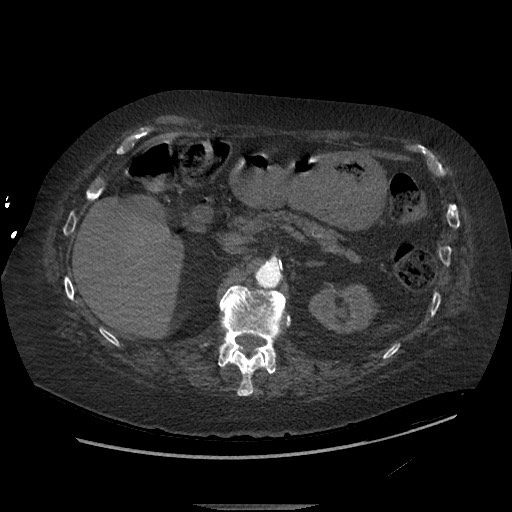 File:Aortoesophageal fistula with endovascular repair (Radiopaedia 73781-84592 Axial 198).jpg