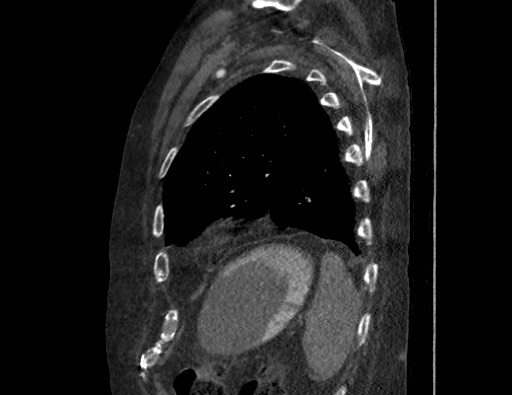 Aortoesophageal fistula with endovascular repair (Radiopaedia 73781-84592 Sagittal C+ CTPA 165).jpg