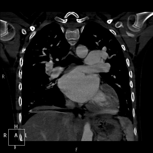File:Aortopulmonary septal defect (Radiopaedia 41990-45013 Coronal C+ CTPA 37).jpg