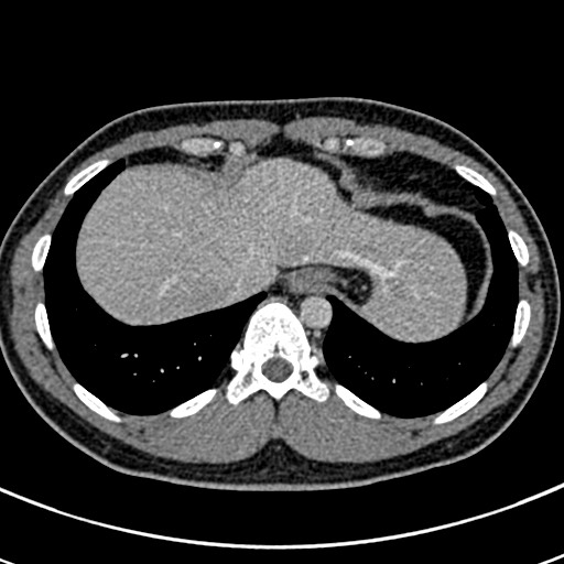 Apical lung mass mimic - neurogenic tumor (Radiopaedia 59918-67521 A 69).jpg